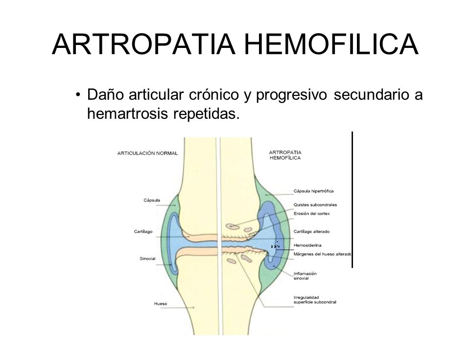 artritis hemofilica